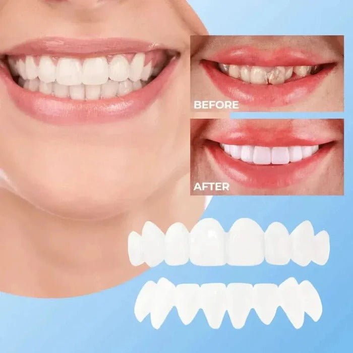 Veneers for Teeth with Natural White Finish - TRENDVYO